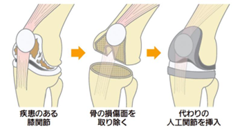 人工関節の脱臼に要注意！人工関節が脱臼する原因と予防法を解説