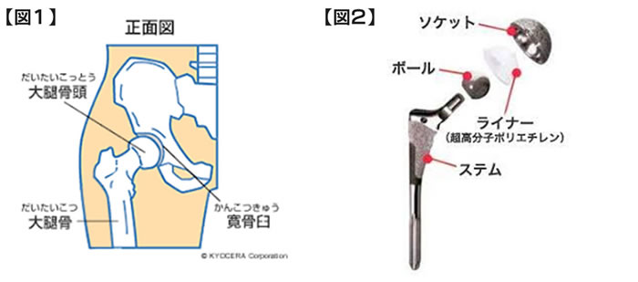 一度の手術で一生使える?人工関節の寿命と長持ちさせる方法を解説