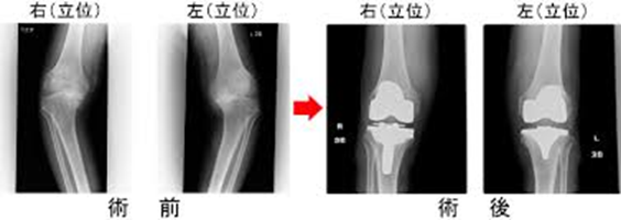 【画像1】両側同時手術の術前と術後のレントゲン写真