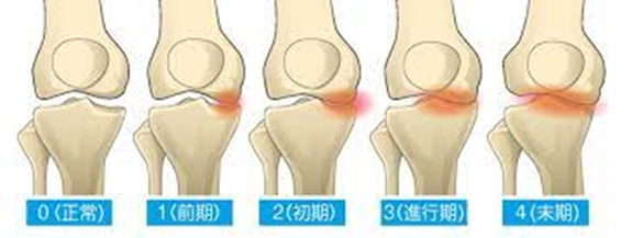 【画像2】　変形性膝関節症の進行度合い