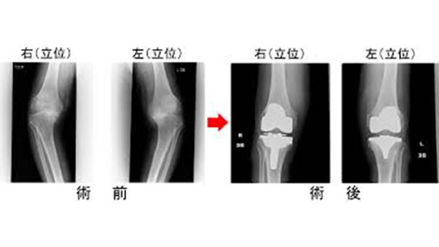 人工膝関節手術を左右同時におこなう両側同時人工関節手術を解説