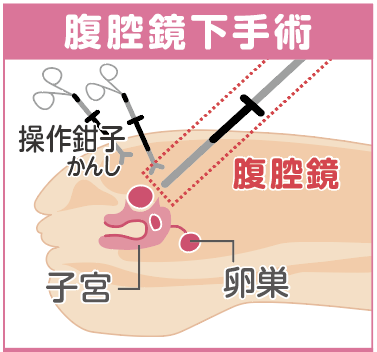 腹腔鏡手術の術中[イラスト]