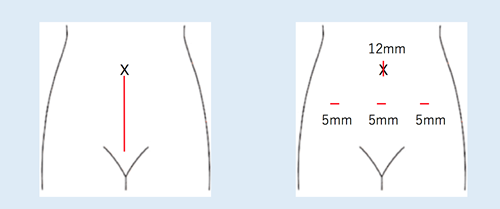 腹腔鏡下手術と開腹手術の傷の違い[図]