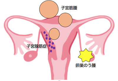 卵巣のう腫・子宮筋腫・子宮腺筋症[イラスト]