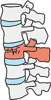 脊椎の主な疾患イメージ図