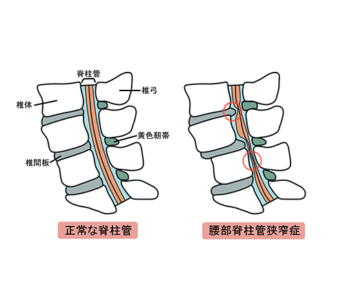 脊椎の主な疾患イメージ図